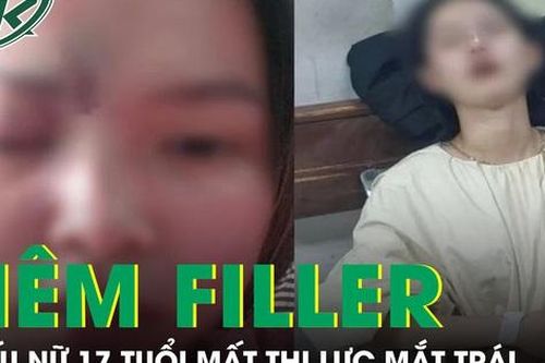 Tiêm filler tại spa, thiếu nữ 17 tuổi mất thị lực mắt trái