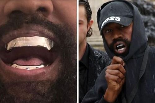Kanye West gây sốc khi nhổ hết răng thật