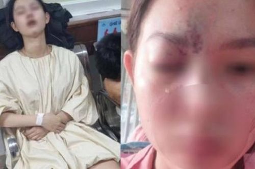 Thiếu nữ 17 tuổi mù mắt vĩnh viễn, liệt nửa não trái sau tiêm filler nâng mũi: Đừng quên 4 điều để an toàn khi làm đẹp