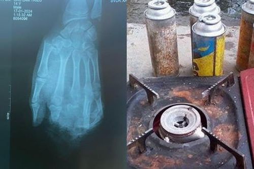Nam sinh 14 tuổi ở Hải Dương gặp tai nạn phải đi cấp cứu khi đang ăn lẩu tại nhà