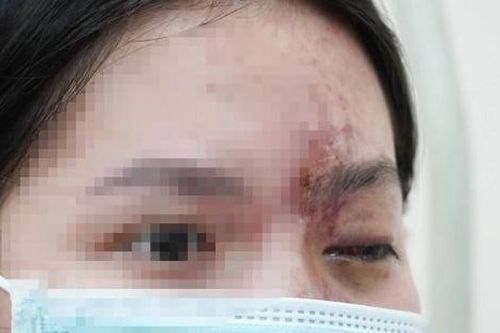 Liên tiếp ca tai biến do làm đẹp đón Tết: Bác sĩ cảnh báo những người tuyệt đối không được 'dao kéo'