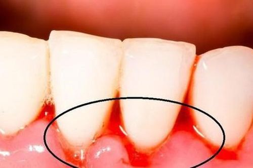 7 lý do khiến chân răng chảy máu thường xuyên
