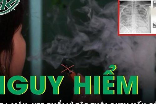 Cô gái ho ra máu, xẹp phổi vì sở thích của nhiều bạn trẻ