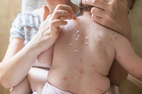 Có ai bị thủy đậu đến 2 lần?