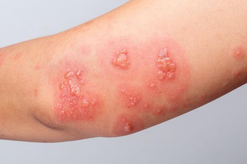 Cô gái 29 tuổi nguy kịch vì bị loài kiến cực độc đốt