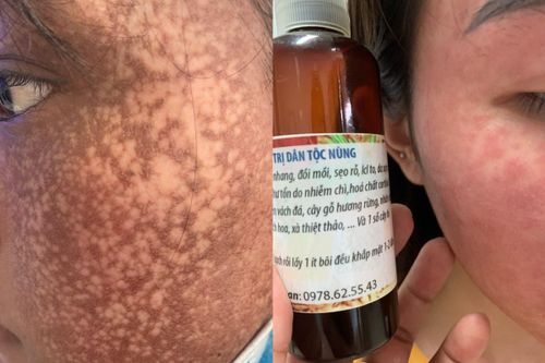Mua mỹ phẩm trên mạng làm đẹp cấp tốc, nhiều người mất Tết vì biến chứng