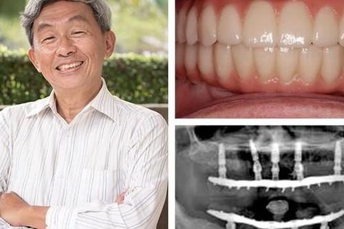 Trồng răng Implant từ tính an toàn cho mọi đối tượng