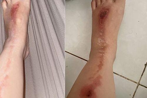 Bị bỏng do pháo hoa bắn trúng người
