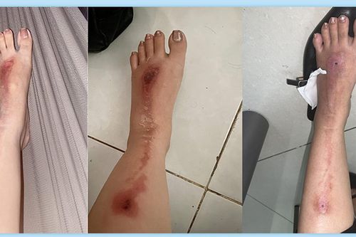 Bắn pháo hoa mừng tiệc tất niên, người phụ nữ bị bỏng nặng