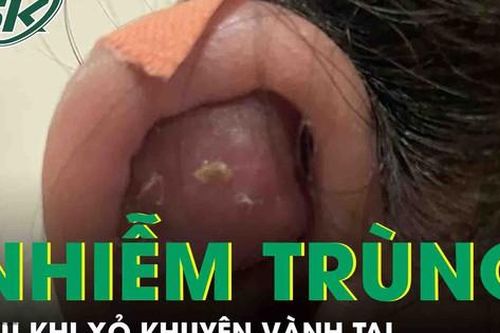 Nhiễm trùng, áp xe chảy mủ sau khi xỏ khuyên vành tai