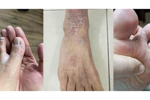 Da khô ngứa khi trời lạnh cẩn thận với viêm da cơ địa