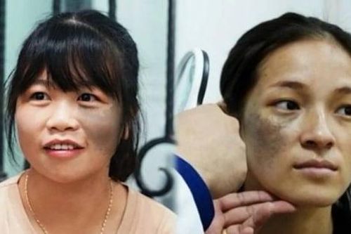 Nỗi khổ tâm của người mẹ mang vết bớt đen trên khuôn mặt