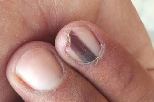 Một phụ nữ phát hiện ung thư từ vệt đen trên móng chân, người Việt cần cảnh giác với dấu hiệu này!
