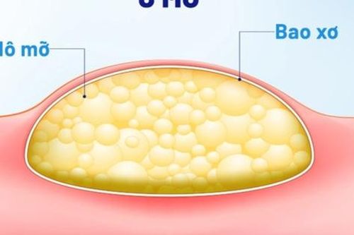 U mỡ có nguy hiểm không?
