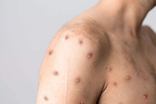 Nhiều người thở máy, biến chứng vì thủy đậu