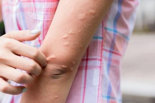 Nổi mề đay do lạnh cần làm gì?