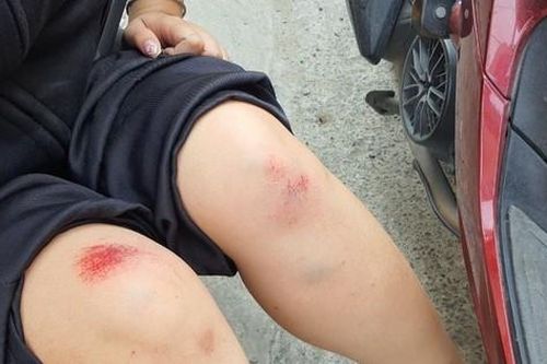 Giữa ban ngày, cô gái trẻ bị giật túi xách ngã nhào xuống đường