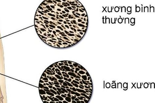 6 loại thực phẩm hàng đầu ngăn ngừa loãng xương