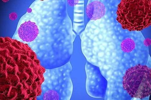 Nấm phổi: Nguyên nhân, triệu chứng và cách điều trị hiệu quả