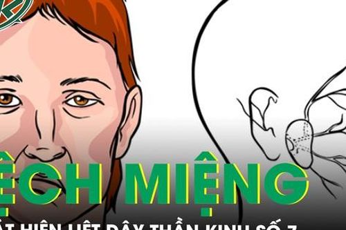 Bé gái đột ngột cười lệch miệng, không ngờ bị liệt dây thần kinh số 7