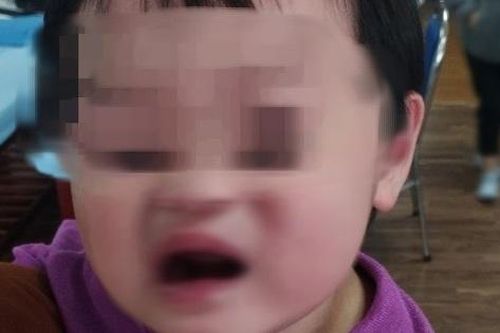Bé 2 tuổi bị liệt mặt, méo miệng sau khi được bố mẹ cho đi xe máy buổi tối, bác sĩ chỉ cách bảo vệ trẻ trong mùa lạnh