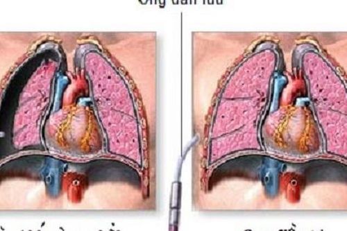 Tràn khí màng phổi ở những người hút thuốc lá