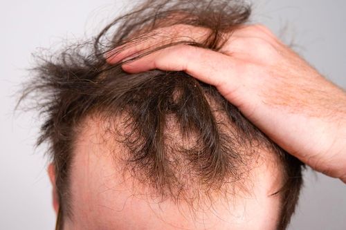 Hói đầu vì mê tẩy tóc