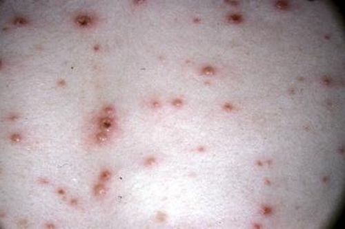 Căn bệnh nguy hiểm khi người mẹ mắc phải trong thai kỳ