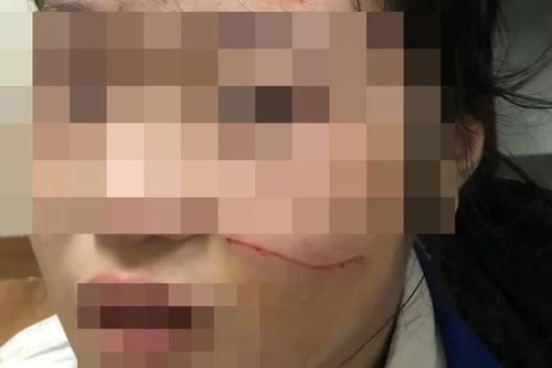 Kỷ luật học sinh đánh bạn chảy máu, rách mặt ở Hà Đông