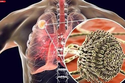 90% người mắc nấm phổi chưa được phát hiện