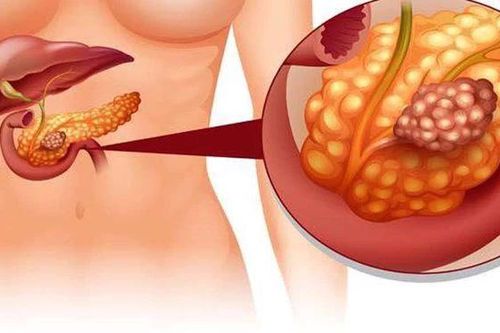 Để không bị viêm tụy cấp ngày Tết