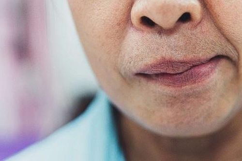 Liệt dây thần kinh số 7 có nguy hiểm không?