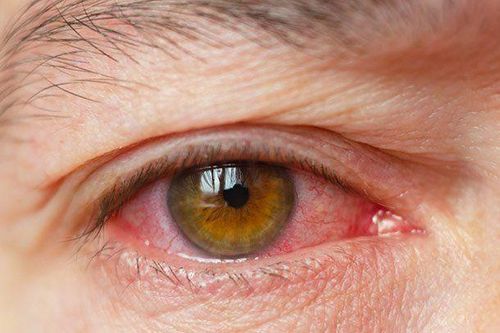 Các loại thuốc phổ biến trị khô mắt cho dân văn phòng