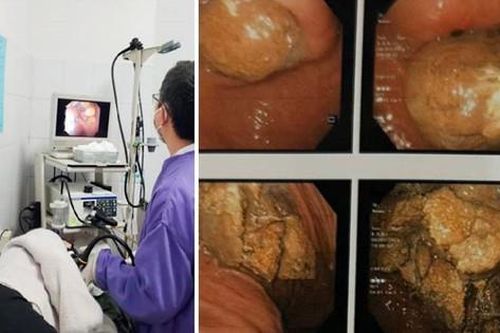 Cảnh giác những thức ăn trong ngày Tết dễ gây tắc ruột