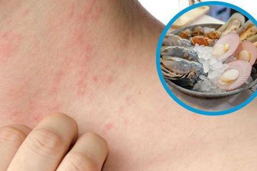 Dị ứng thức ăn và cách nhận biết