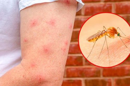 Vì sao có người sơ hở là bị muỗi đốt, người không đề phòng thì lại không bị phát nào?