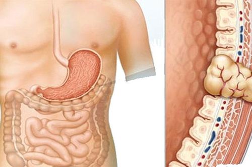 Bác sĩ trả lời: Đã cắt u mô đệm đường tiêu hóa, liệu còn tái phát nữa không?