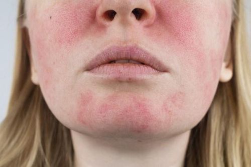 Vì sao bạn đỏ bừng mặt dù chỉ uống một ngụm bia?