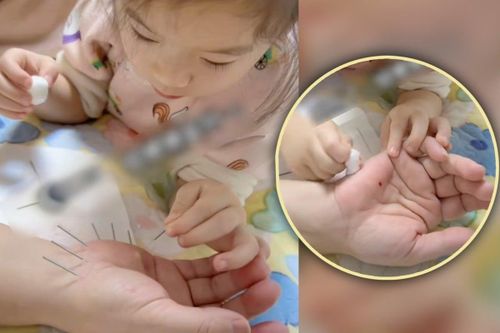 Bé gái 5 tuổi gây choáng với kỹ thuật châm cứu điêu luyện