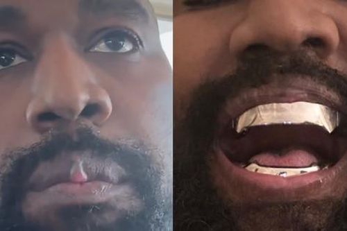 Gương mặt biến dạng của Kanye West sau khi nhổ hết răng