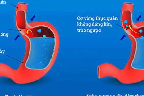 Các biến chứng nguy hiểm của trào ngược dạ dày thực quản