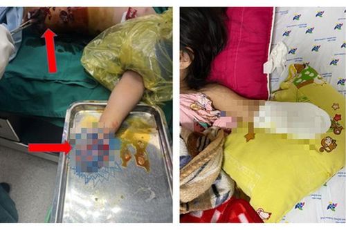 Nhặt pháo, bé gái 5 tuổi mất bàn tay trái vĩnh viễn