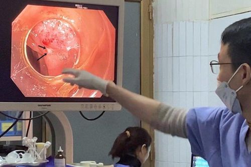 Nuốt phải tăm tre, cô gái bị thủng ruột non