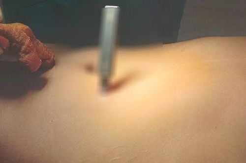 Giận vợ, thanh niên 29 tuổi dùng dao tự đâm thủng bụng mình