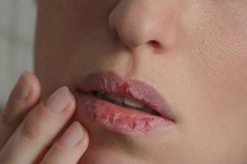 Dưỡng ẩm đầy đủ môi vẫn khô và bong tróc, nguyên nhân do đâu?