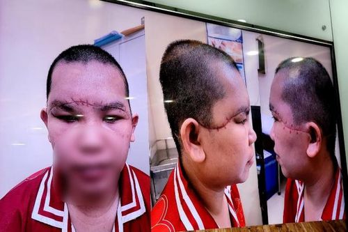 Nữ công nhân bị máy cuốn sợi quấn vào tóc kéo tróc toàn bộ da đầu