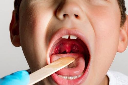 Cách nhanh nhất để biết bạn bị viêm amidan do vi khuẩn hay virus