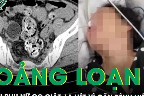 Hoảng loạn, hay la hét, người phụ nữ được phát hiện mắc bệnh lý viêm não tự miễn hiếm gặp