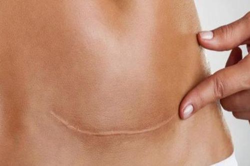 Khuyết sẹo mổ lấy thai có nhất thiết phải mổ?