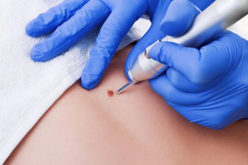 Cô gái 26 tuổi đi cấp cứu vì tự đốt mụn cơm sinh dục
